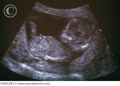 Fătul - așa cum se vede la echografie